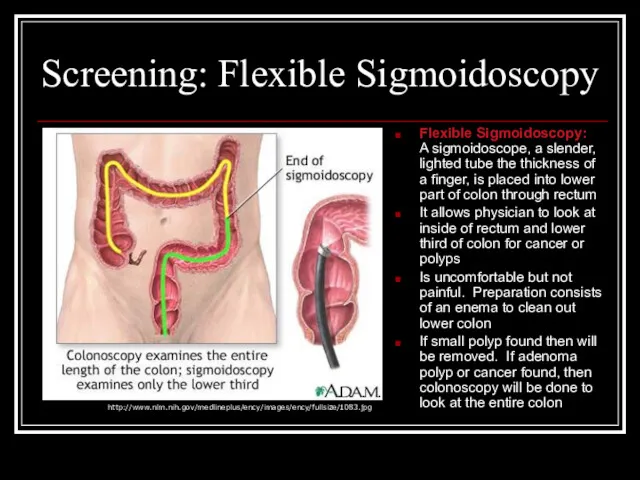 Screening: Flexible Sigmoidoscopy Flexible Sigmoidoscopy: A sigmoidoscope, a slender, lighted tube the thickness