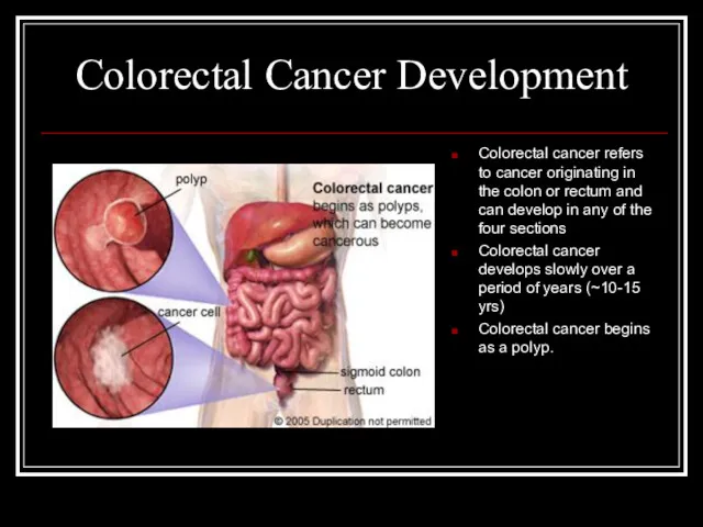 Colorectal Cancer Development Colorectal cancer refers to cancer originating in the colon or