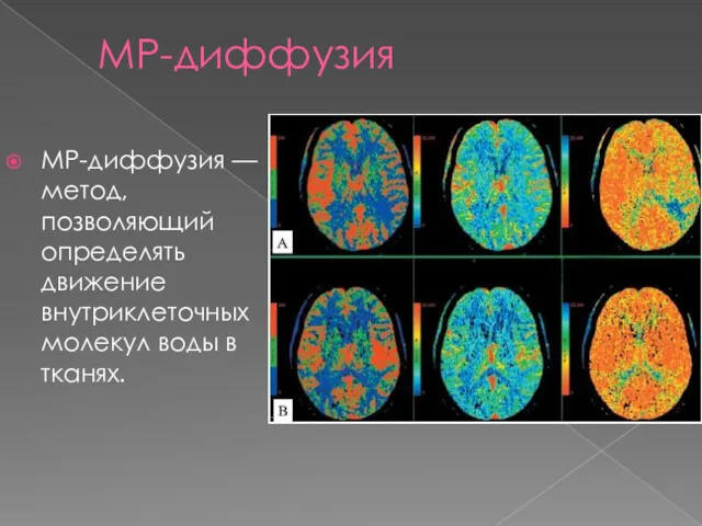 МР-диффузия МР-диффузия — метод, позволяющий определять движение внутриклеточных молекул воды в тканях.