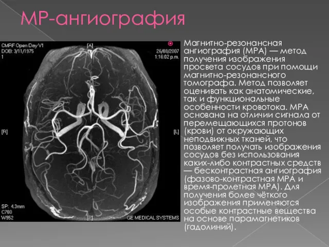 МР-ангиография Магнитно-резонансная ангиография (МРА) — метод получения изображения просвета сосудов