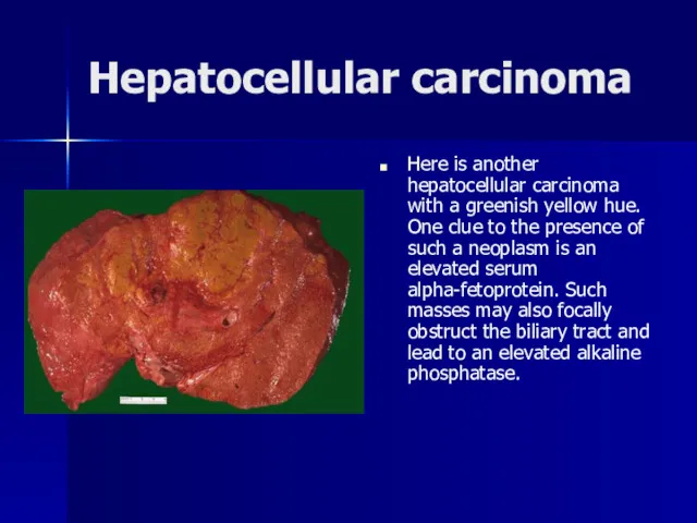 Hepatocellular carcinoma Here is another hepatocellular carcinoma with a greenish