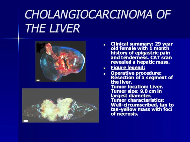 CHOLANGIOCARCINOMA OF THE LIVER Clinical summary: 29 year old female