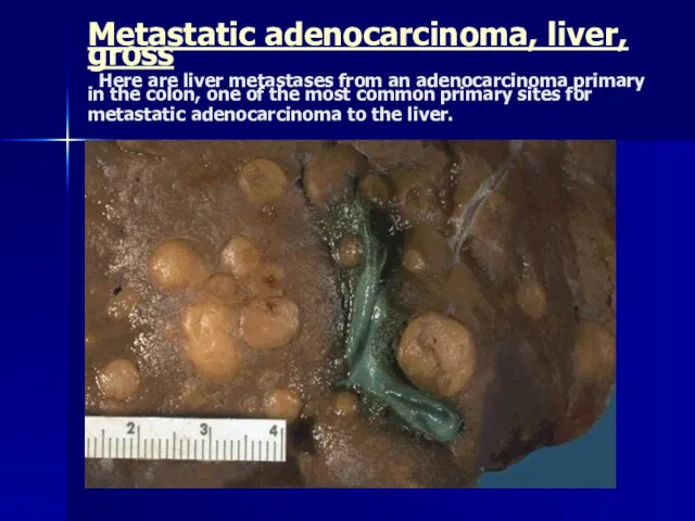 Metastatic adenocarcinoma, liver, gross Here are liver metastases from an