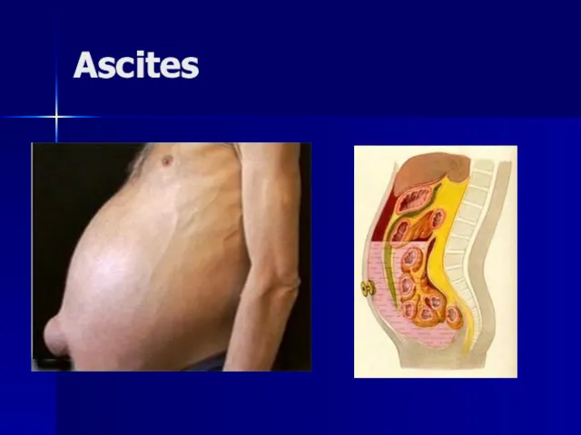 Ascites