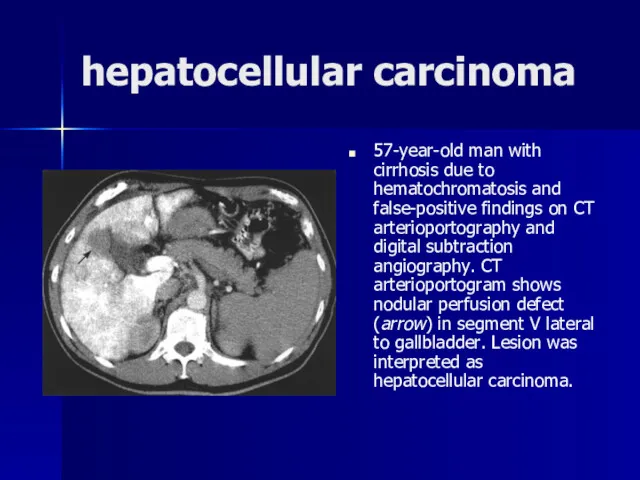 hepatocellular carcinoma 57-year-old man with cirrhosis due to hematochromatosis and