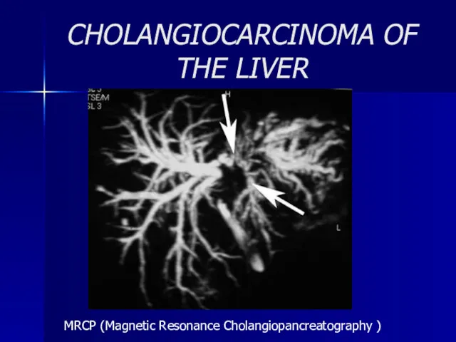 CHOLANGIOCARCINOMA OF THE LIVER MRCP (Magnetic Resonance Cholangiopancreatography )