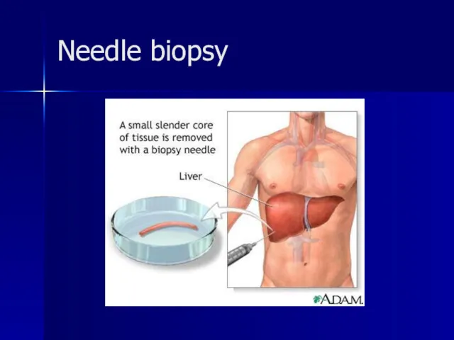 Needle biopsy