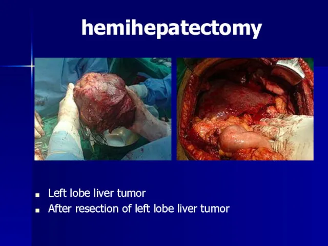 hemihepatectomy Left lobe liver tumor After resection of left lobe liver tumor