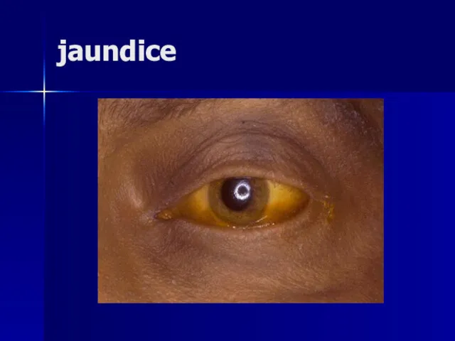 jaundice