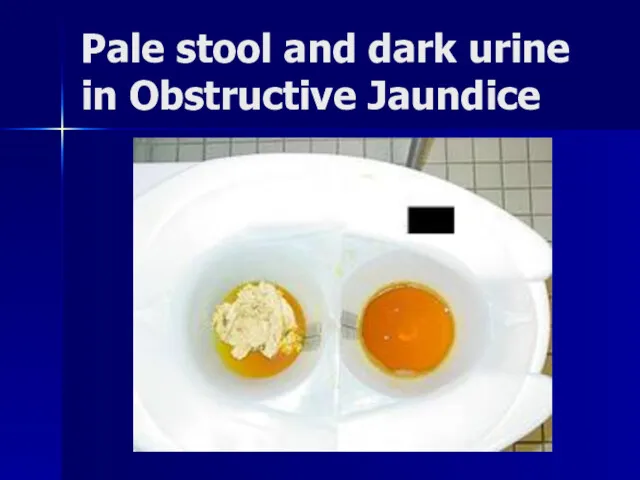 Pale stool and dark urine in Obstructive Jaundice