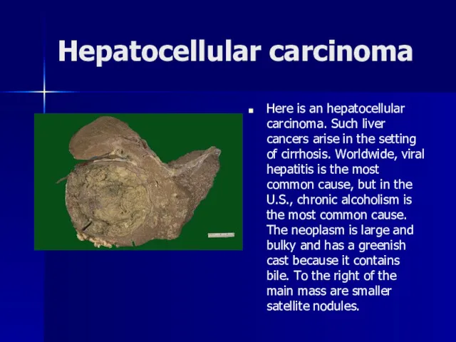 Hepatocellular carcinoma Here is an hepatocellular carcinoma. Such liver cancers