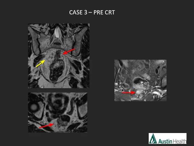 CASE 3 – PRE CRT