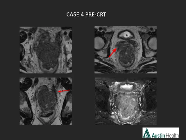 CASE 4 PRE-CRT