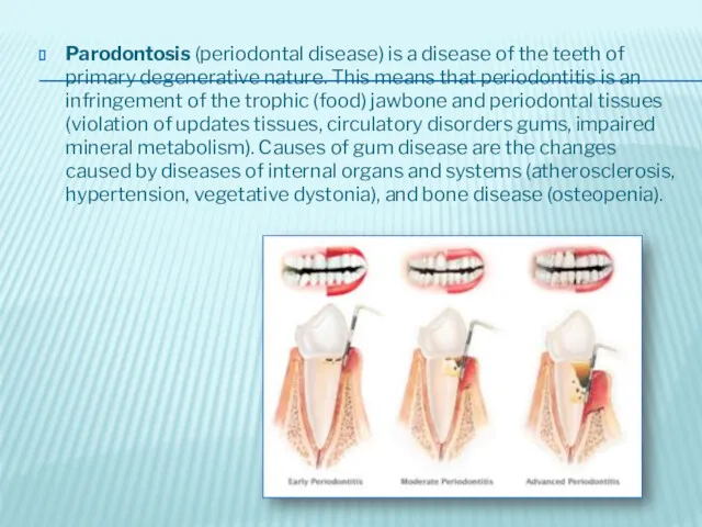 Parodontosis (periodontal disease) is a disease of the teeth of