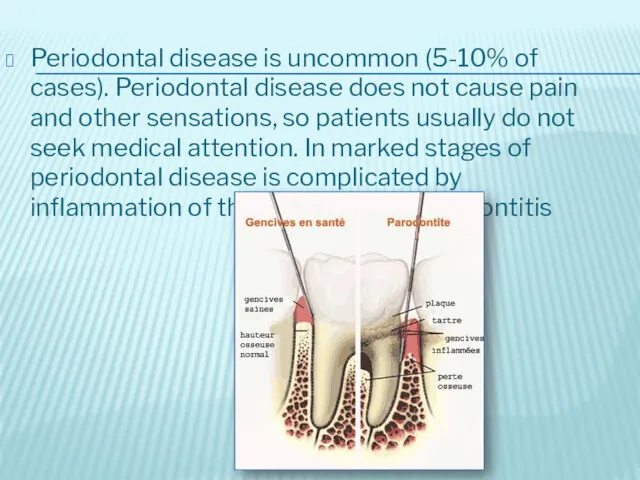 Periodontal disease is uncommon (5-10% of cases). Periodontal disease does