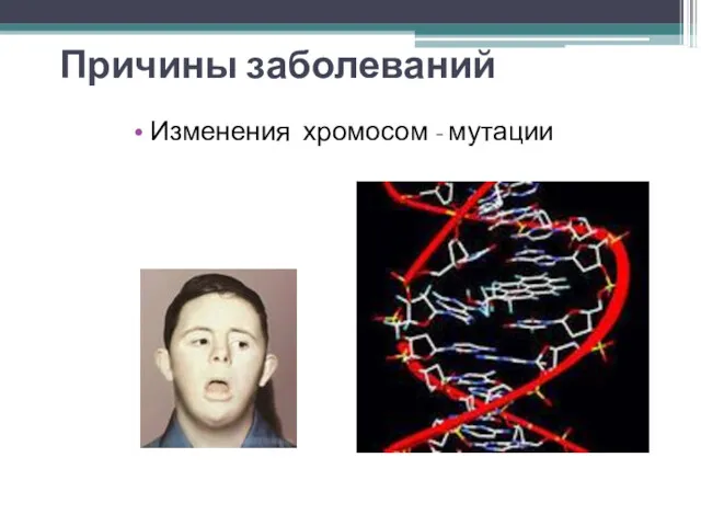 Причины заболеваний Изменения хромосом - мутации