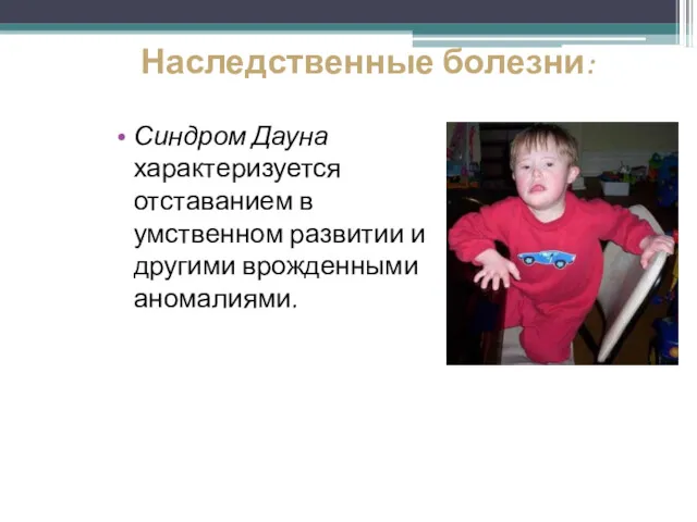 Наследственные болезни: Синдром Дауна характеризуется отставанием в умственном развитии и другими врожденными аномалиями.