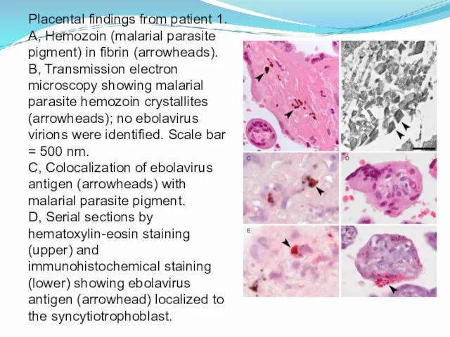 Placental findings from patient 1. A, Hemozoin (malarial parasite pigment)