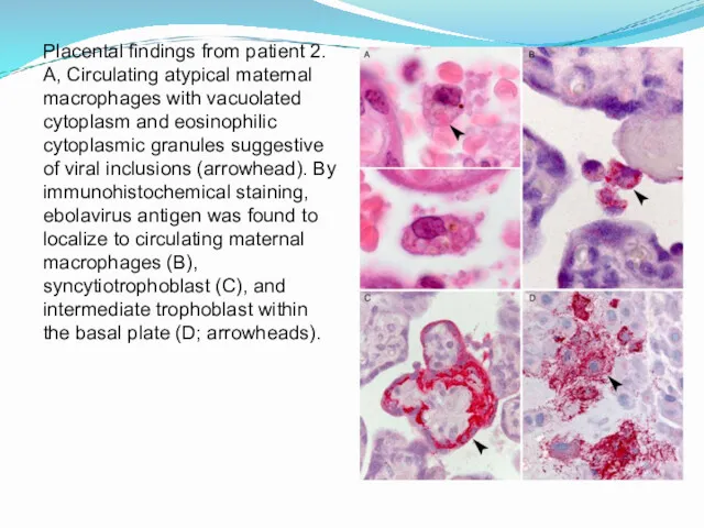 Placental findings from patient 2. A, Circulating atypical maternal macrophages