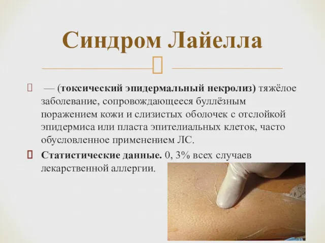 — (токсический эпидермальный некролиз) тяжёлое заболевание, сопровождающееся буллёзным поражением кожи