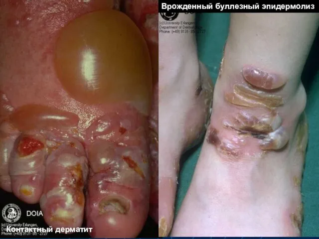 Контактный дерматит Врожденный буллезный эпидермолиз