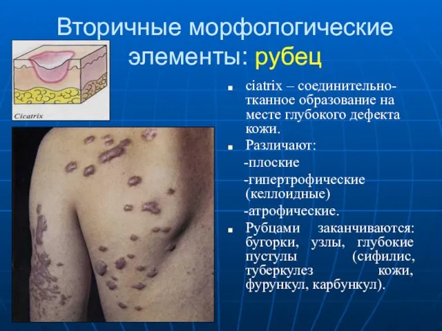 Вторичные морфологические элементы: рубец ciatrix – соединительно-тканное образование на месте