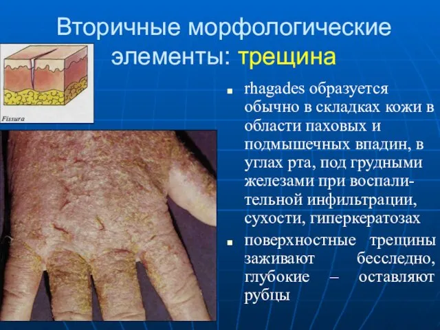 Вторичные морфологические элементы: трещина rhagades образуется обычно в складках кожи
