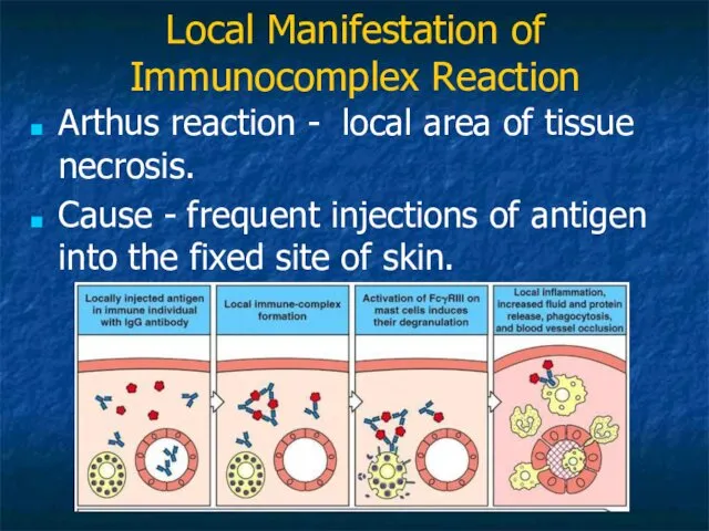 Local Manifestation of Immunocomplex Reaction Arthus reaction - local area