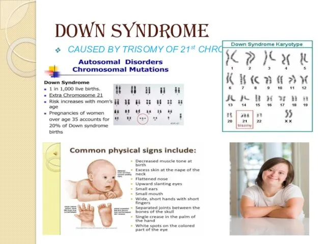 DOWN SYNDROME CAUSED BY TRISOMY OF 21st CHROMOSOME