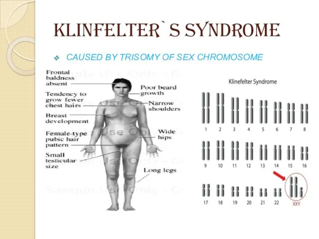 KLINFELTER`s SYNDROME CAUSED BY TRISOMY OF SEX CHROMOSOME