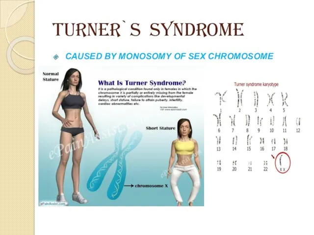 TURNER`S SYNDROME CAUSED BY MONOSOMY OF SEX CHROMOSOME