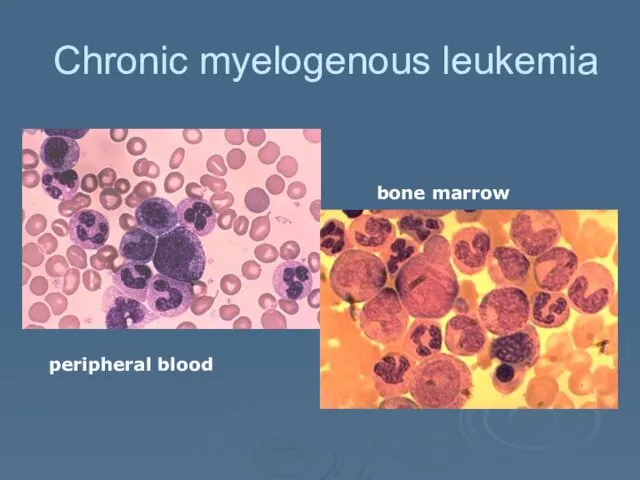 Chronic myelogenous leukemia peripheral blood bone marrow