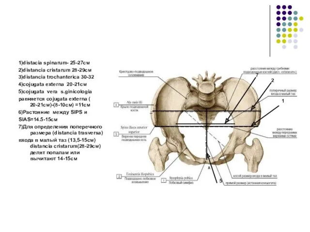 1)distacia spinarum- 25-27см 2)distancia cristarum 28-29см 3)distancia trochanterica 30-32 4)cojugata