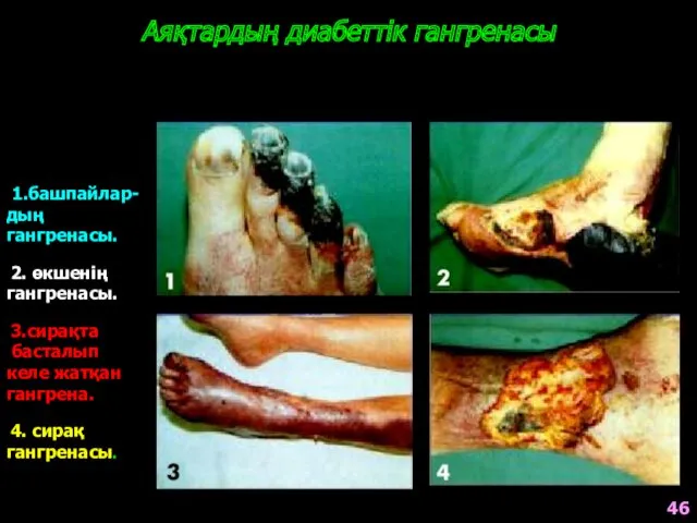 Аяқтардың диабеттік гангренасы 1.башпайлар- дың гангренасы. 2. өкшенің гангренасы. 3.сирақта