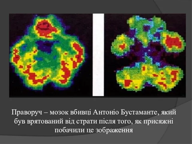 Праворуч – мозок вбивці Антоніо Бустаманте, який був врятований від