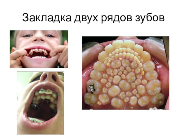 Закладка двух рядов зубов