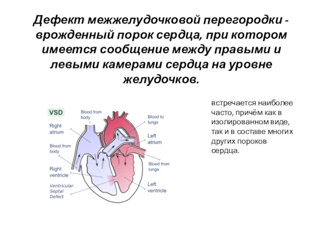 Дефект межжелудочковой перегородки - врожденный порок сердца, при котором имеется