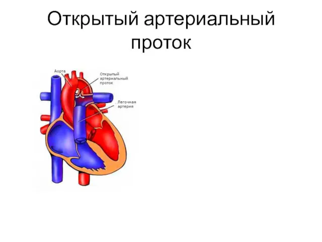 Открытый артериальный проток
