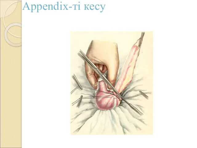 Appendix-ті кесу