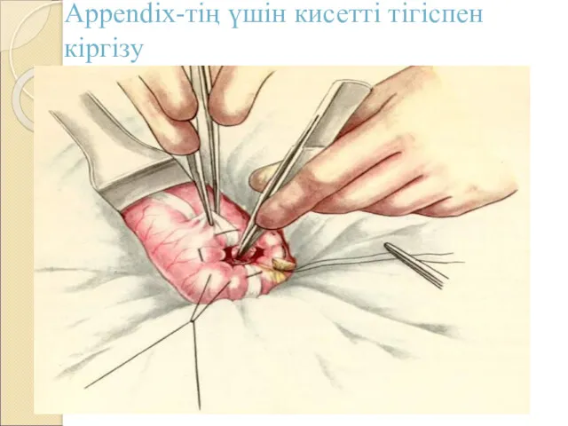 Appendix-тің үшін кисетті тігіспен кіргізу