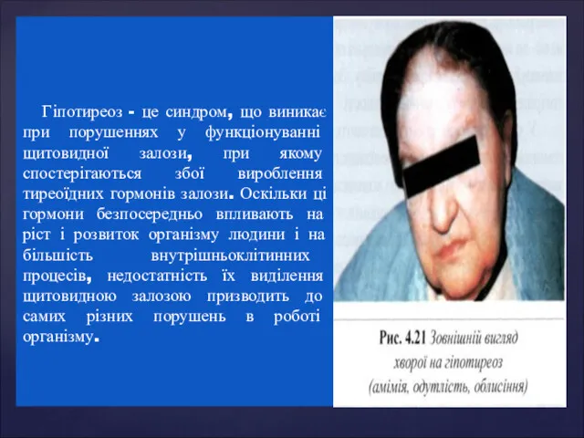 Гіпотиреоз - це синдром, що виникає при порушеннях у функціонуванні