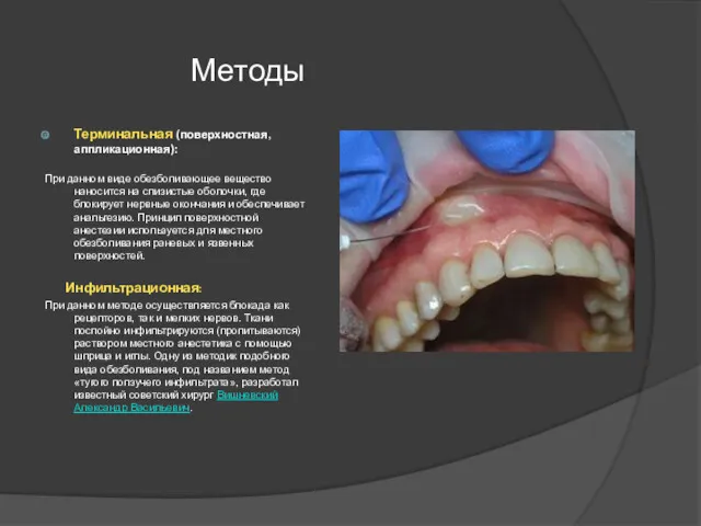 Методы Терминальная (поверхностная, аппликационная): При данном виде обезболивающее вещество наносится на слизистые оболочки,