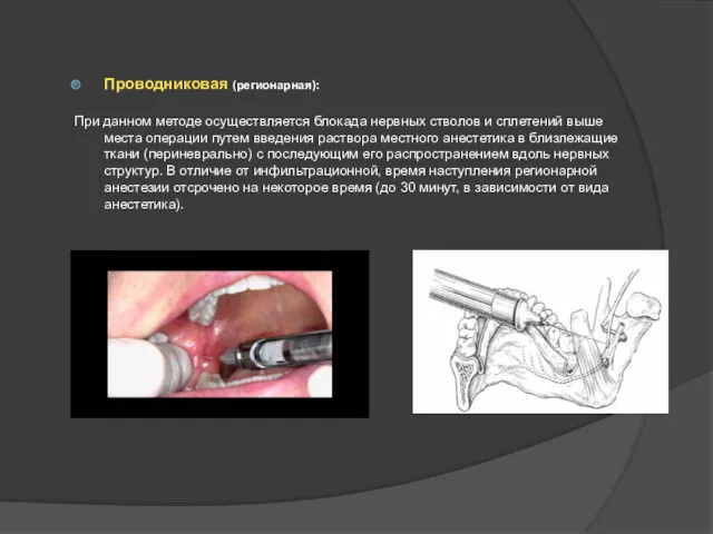 Проводниковая (регионарная): При данном методе осуществляется блокада нервных стволов и