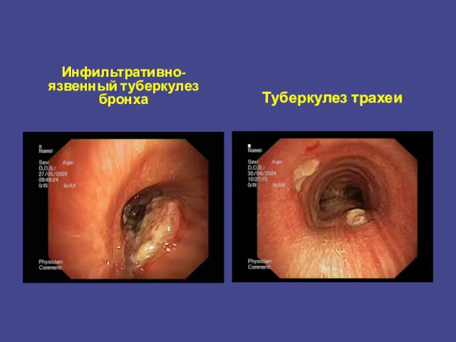 Инфильтративно-язвенный туберкулез бронха Туберкулез трахеи
