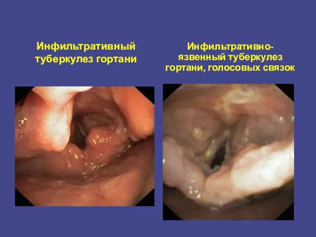 Инфильтративный туберкулез гортани Инфильтративно-язвенный туберкулез гортани, голосовых связок