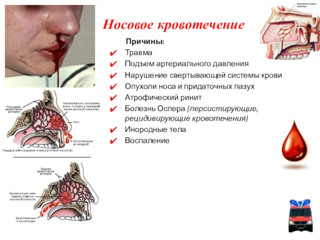 Носовое кровотечение Причины: Травма Подъем артериального давления Нарушение свертывающей системы