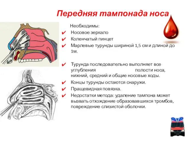 Передняя тампонада носа Необходимы: Носовое зеркало Коленчатый пинцет Марлевые турунды