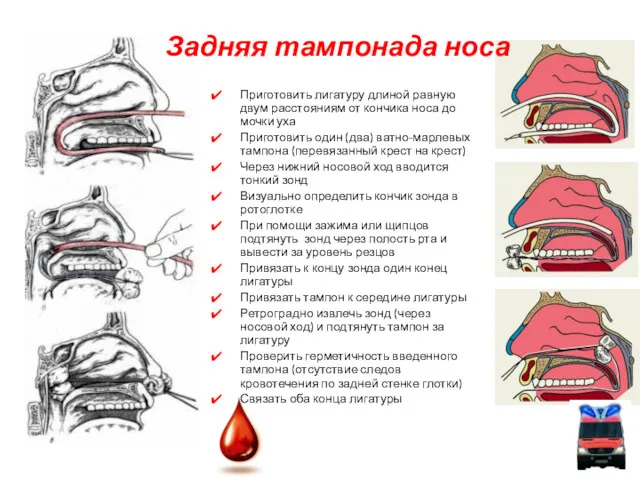 Задняя тампонада носа Приготовить лигатуру длиной равную двум расстояниям от