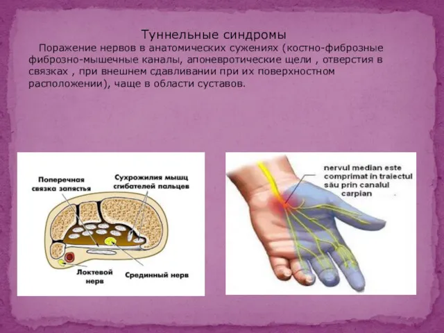 Туннельные синдромы Поражение нервов в анатомических сужениях (костно-фиброзные фиброзно-мышечные каналы,