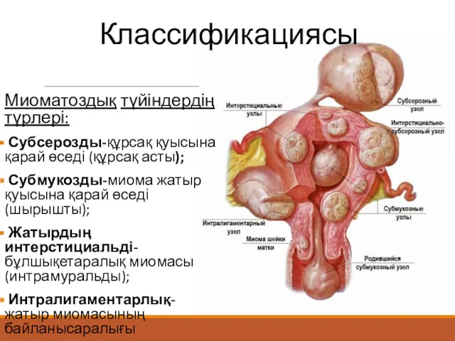 Классификациясы Миоматоздық түйіндердің түрлері: Субсерозды-құрсақ қуысына қарай өседі (құрсақ асты);